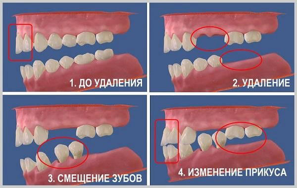 Смещение зубов